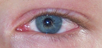 ontstoken oog